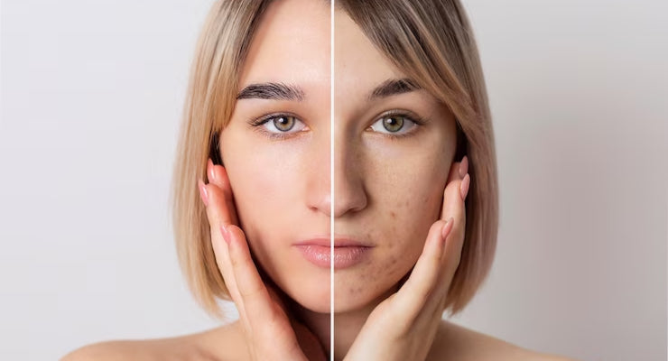 Best Face Serum for Acne and Dark Spots