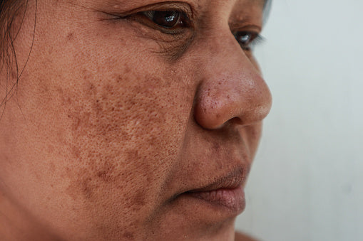 How to Get Rid of Hyperpigmentation