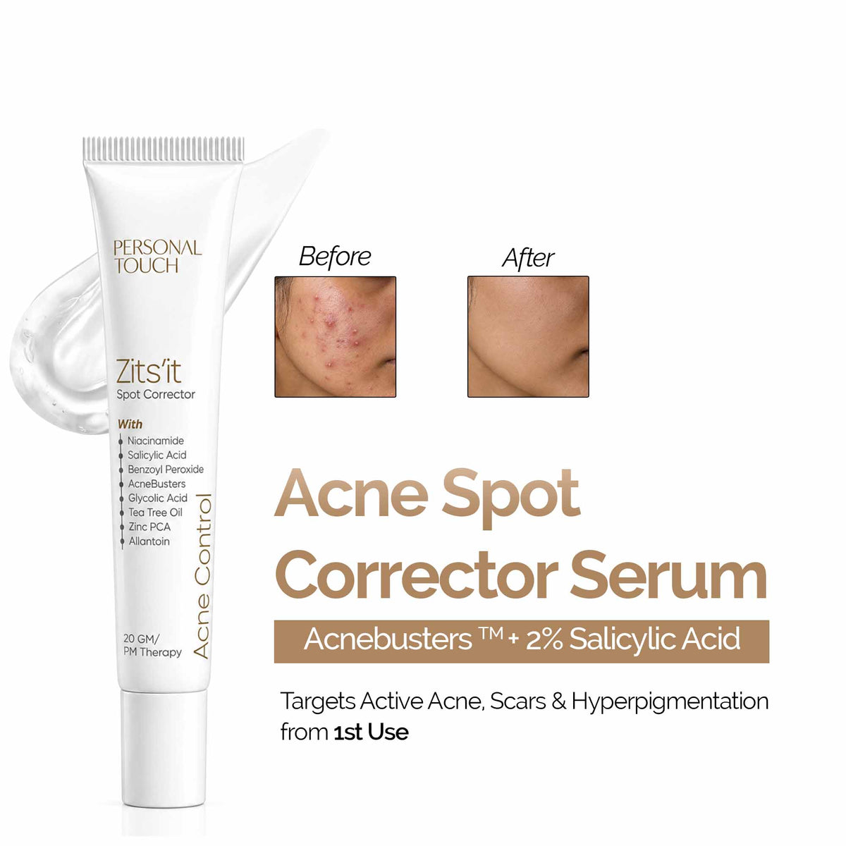Zitsit Spot Corrector For Active Acne | Acne Scars | Salicylic | Niacinamide | Zinc - Acne Prone & Active Acne | 20g
