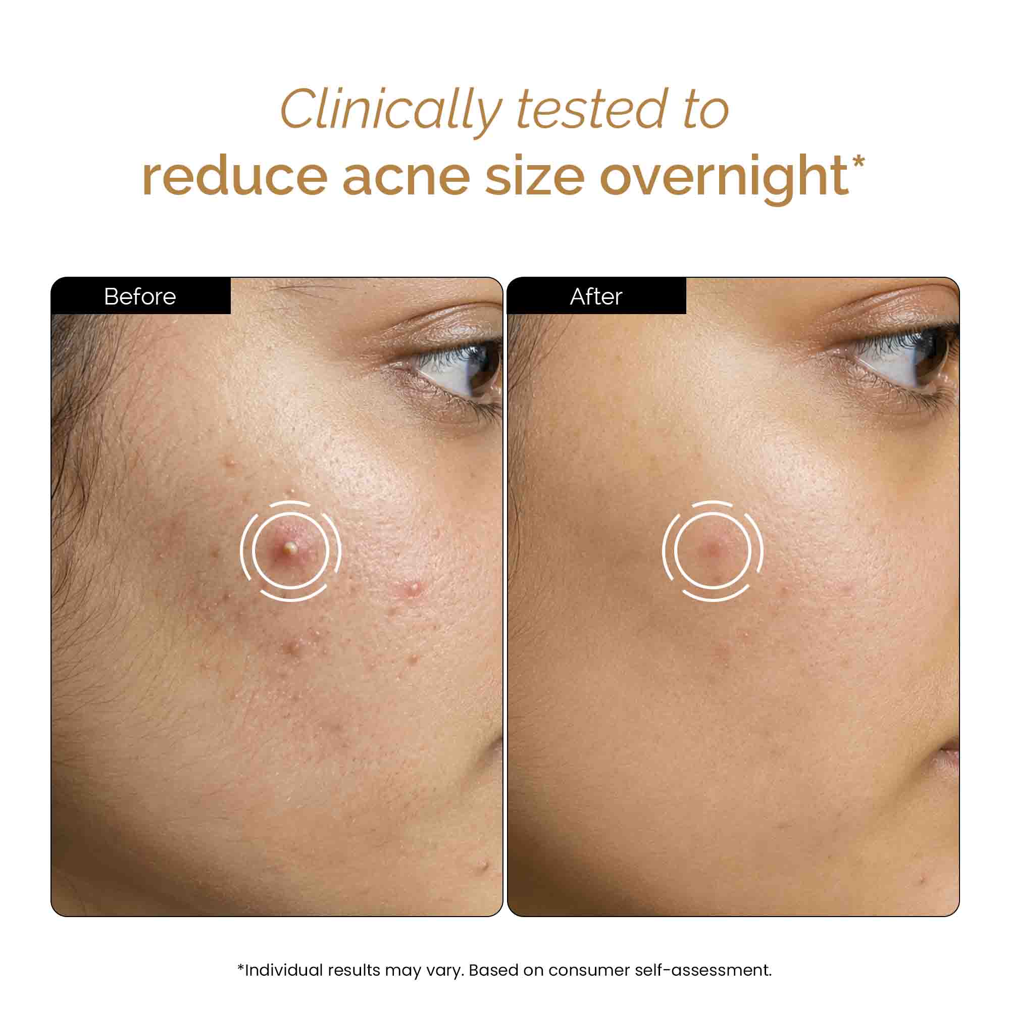 Zitsit Spot Corrector For Active Acne | Acne Scars | Salicylic | Niacinamide | Zinc - Acne Prone & Active Acne | 20g