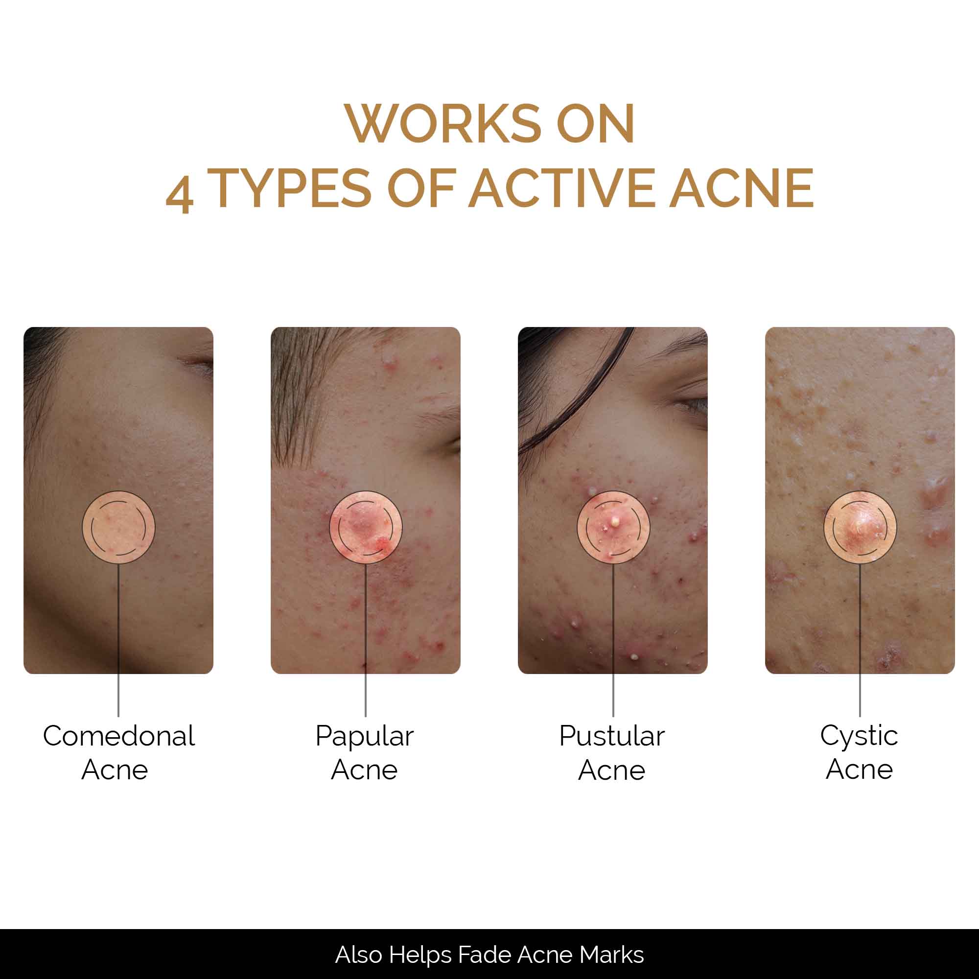Zitsit Spot Corrector For Active Acne | Acne Scars | Salicylic | Niacinamide | Zinc - Acne Prone & Active Acne | 20g