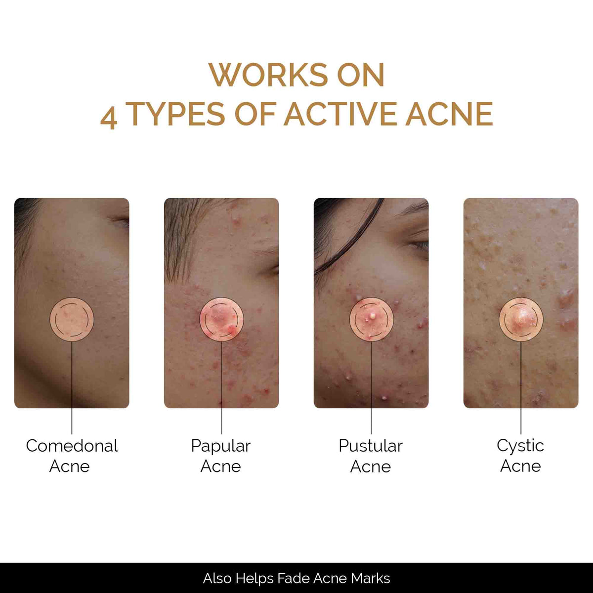 Zitsit Spot Corrector For Active Acne | Acne Scars | Salicylic | Niacinamide | Zinc - Acne Prone & Active Acne | 20g