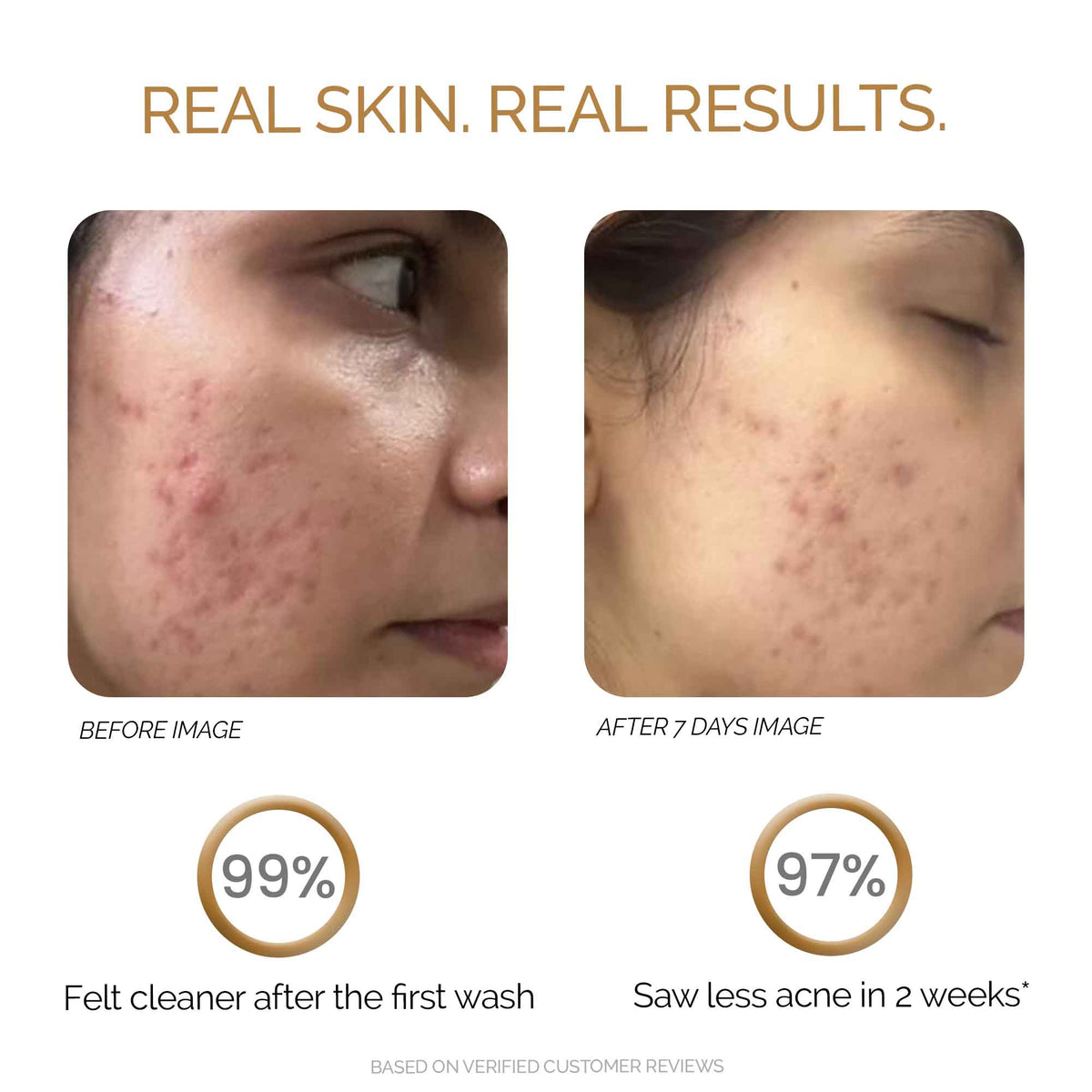 Zitsit Foaming Acne Face Wash with Glycolic & Salicylic Acid 50 ml