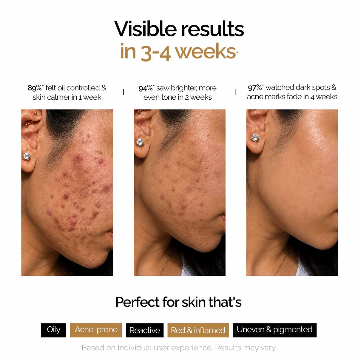 Niacid 5 Niacinamide Serum Spray– Oil Control, Dark Spots, Acne Marks