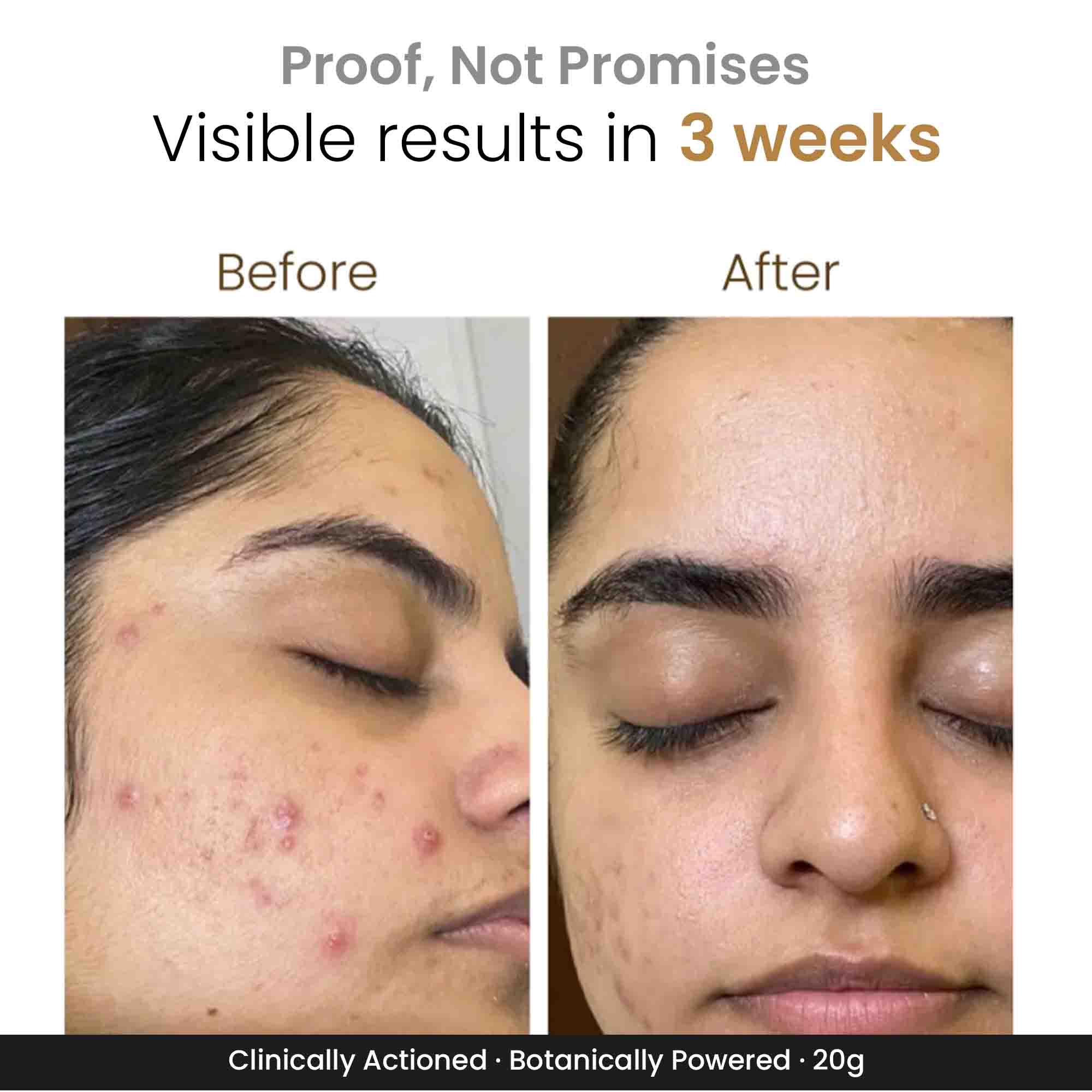 Zitsit Spot Corrector For Active Acne | Acne Scars | Salicylic | Niacinamide | Zinc - Acne Prone & Active Acne | 20g