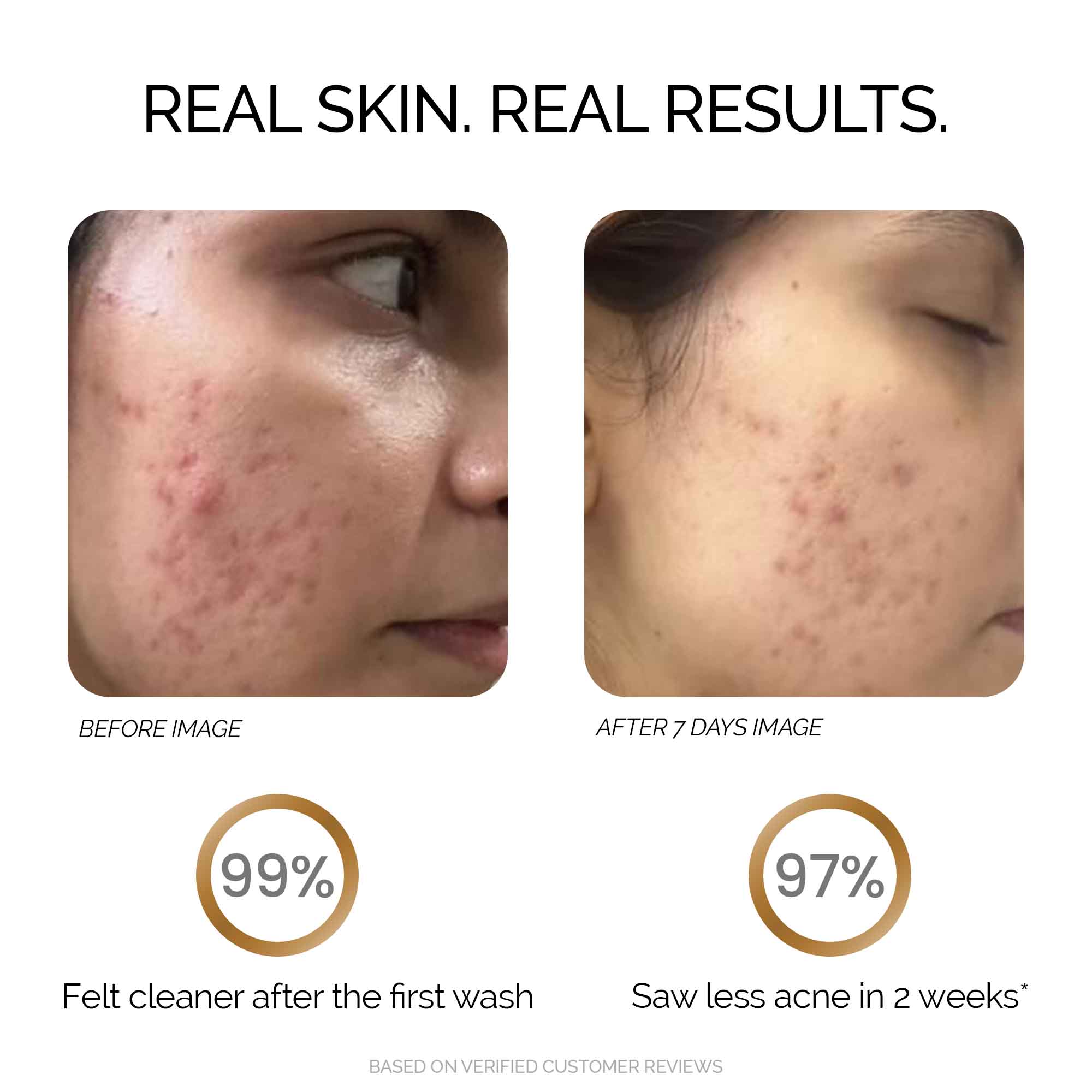 Zitsit Foaming Acne Face Wash with Glycolic & Salicylic Acid 50 ml