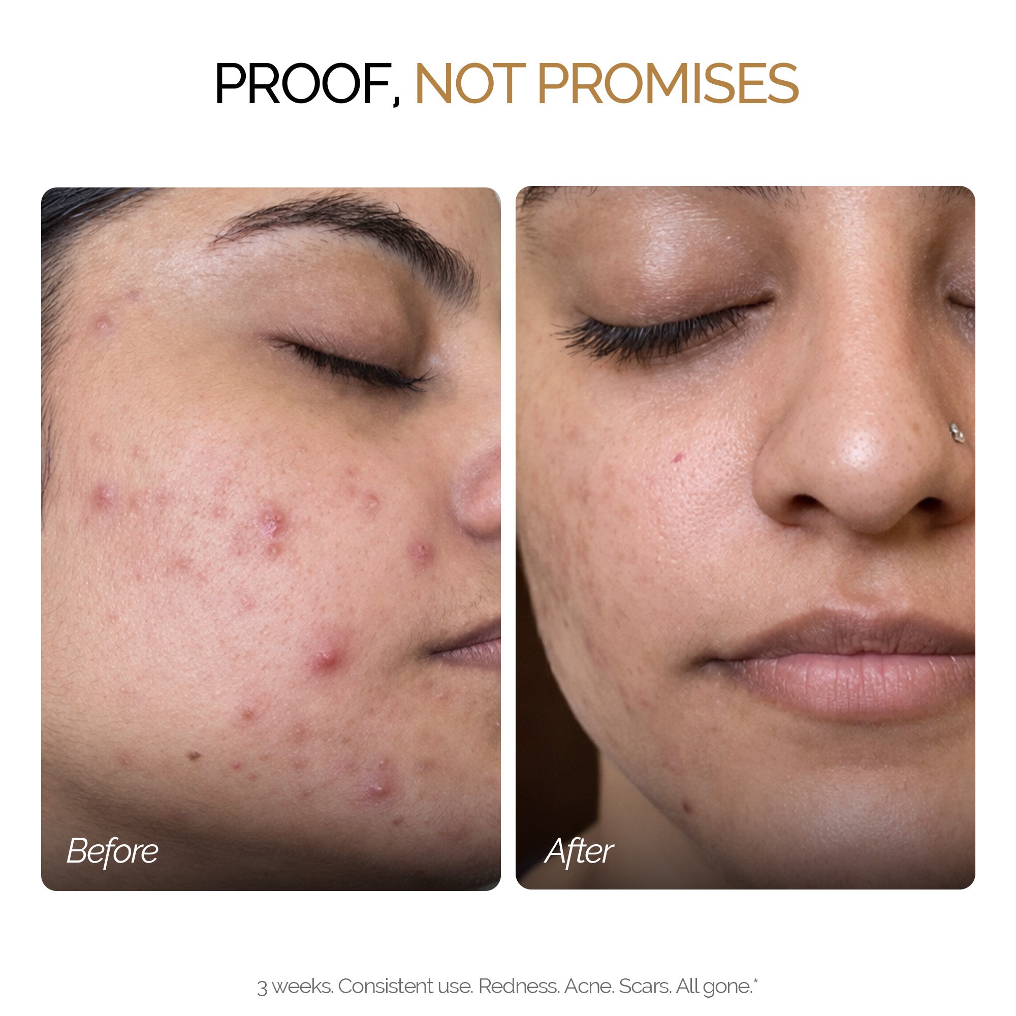Anti Acne Combo - Zitsit Facewash, Spot Corrector & Towel