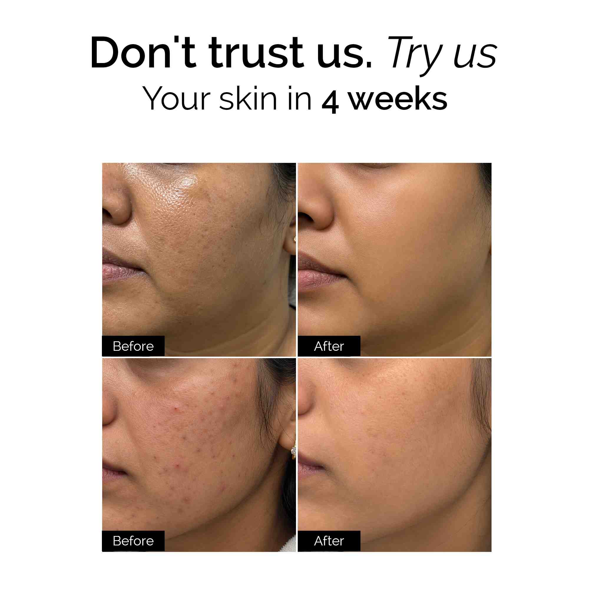 Brightening Therapy Trial Kit | for Oily & Combination Skin | Facewash + Serum + Moisturiser + Sunscreen