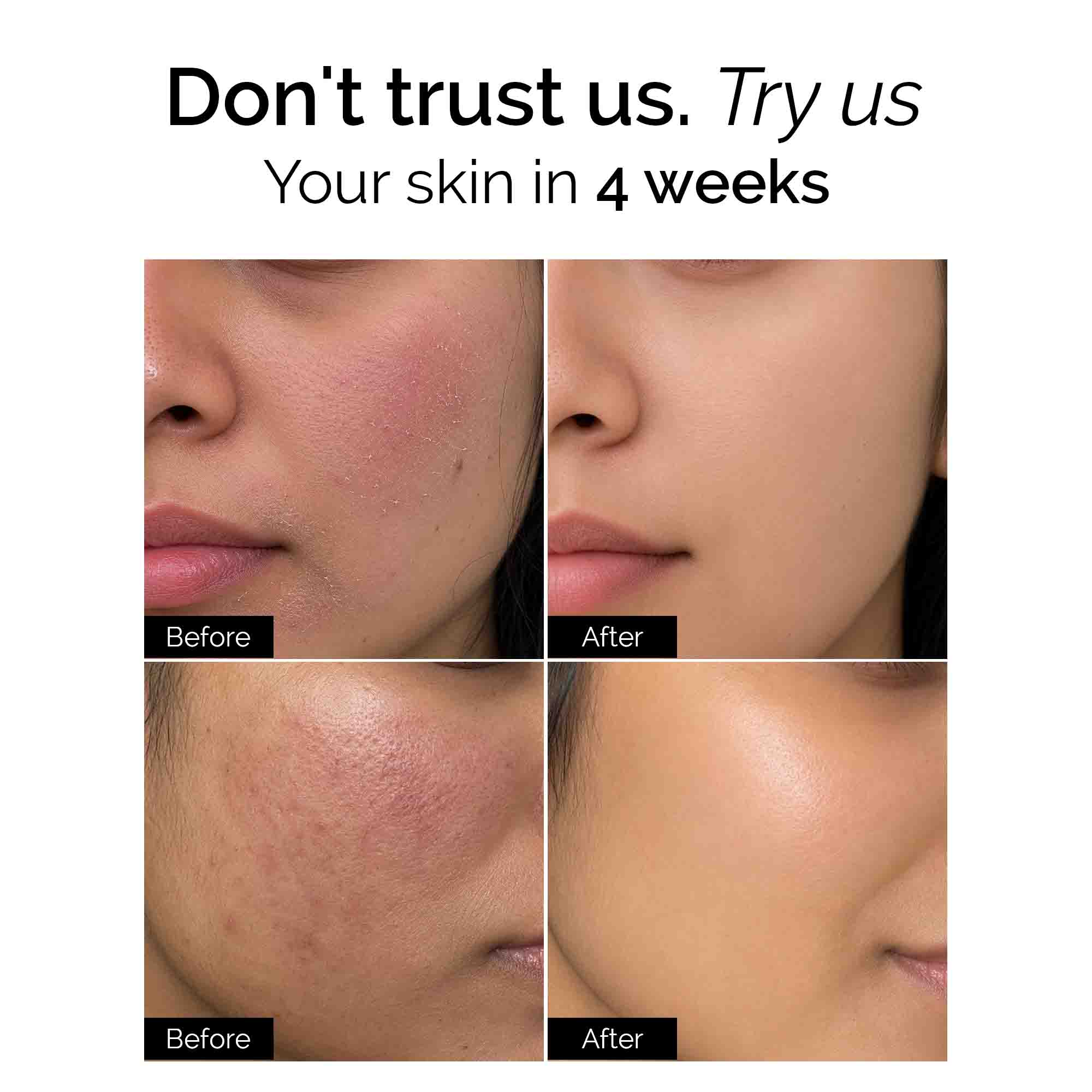 Dry Defence Therapy Trial Kit |  Facewash + Serum + Moisturiser + Sunscreen | for Dry & Sensitive Skin