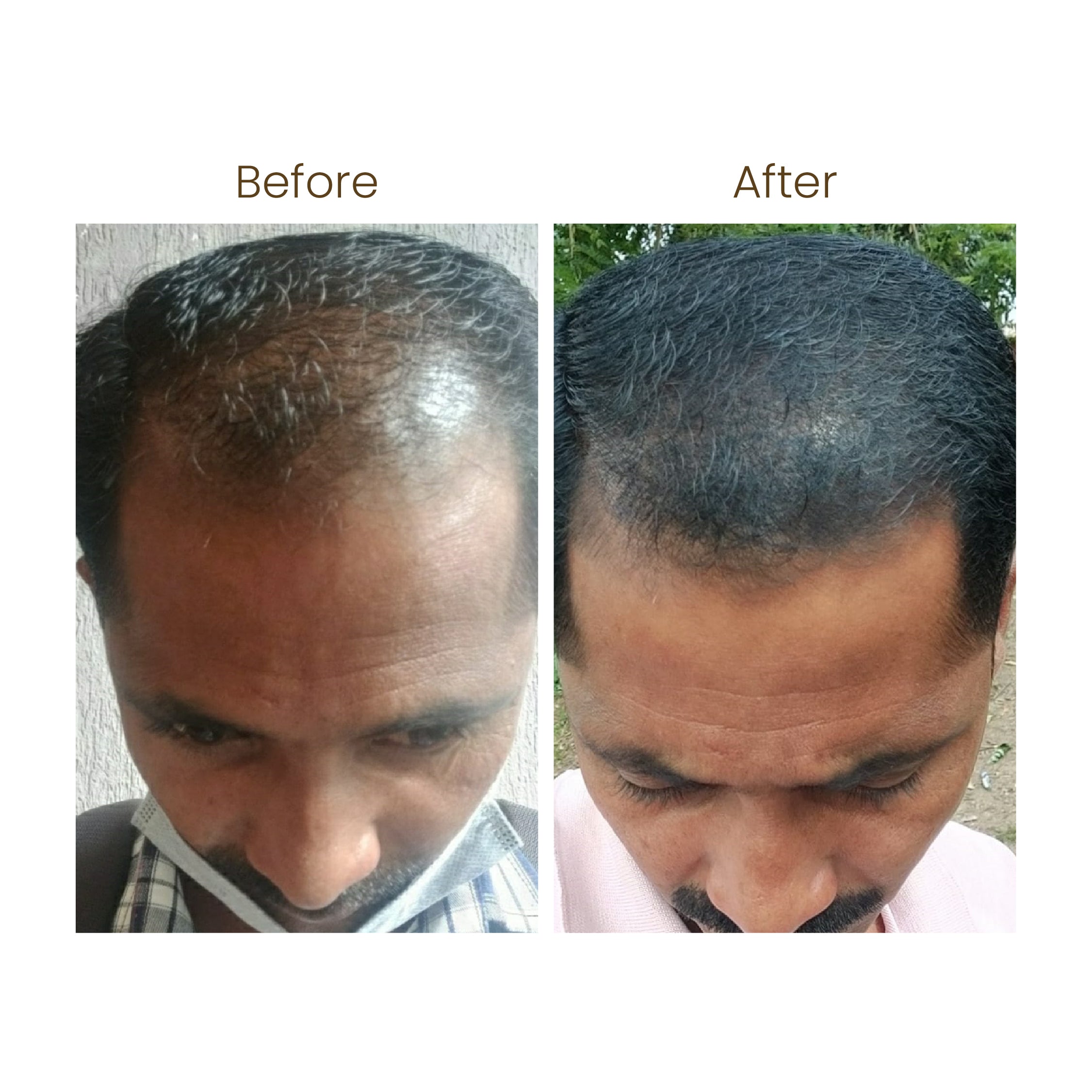 Hair Up Hair Growth & Hairfall Control Serum | 11 Clinically Approved Ingredients | Redensyl & Anagen | 50ml
